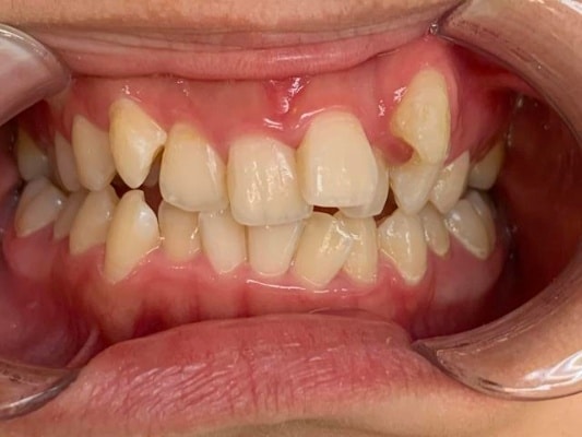 出っ歯とガチャガチャの歯並びを治療したAさん
