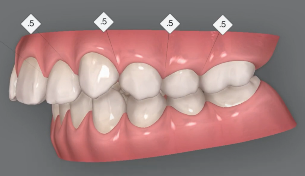 抜歯を回避して出っ歯をインビザラインで治す方法