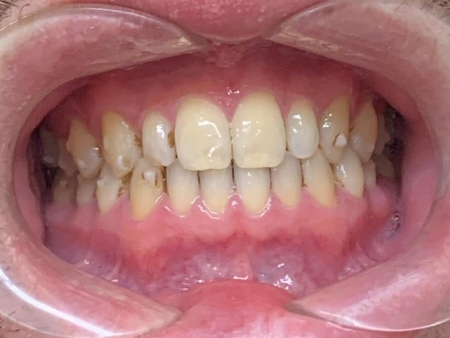 手術なしのマウスピース矯正で改善した治療後の正面の歯列写真